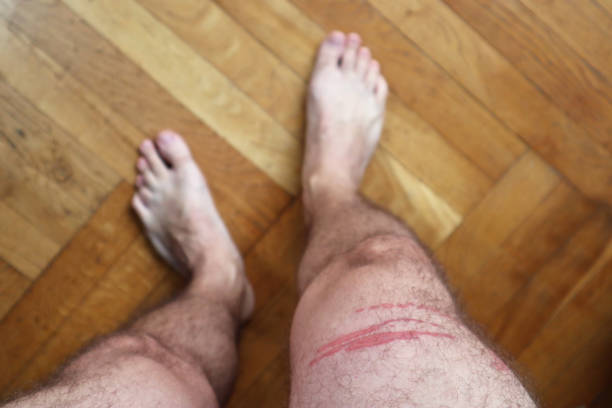 istock A jellyfish sting burn on a man's leg 1441615848
