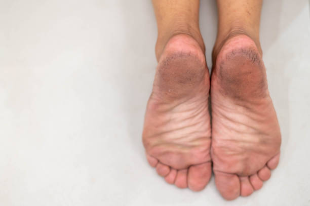 Feet with dry skin for show about the unhealthy foot. Must be often treatment in everyday. stock photo