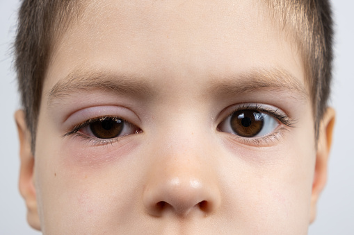 Conjoctive Photo libre de droit de Œil Dun Enfant Atteint De Conjonctivite ...
