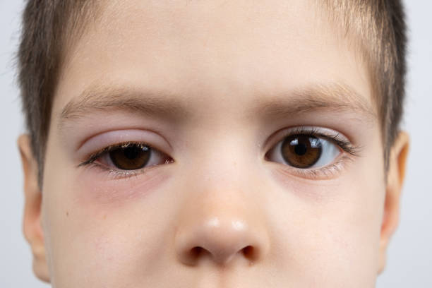 œil d’un enfant atteint de conjonctivite, inflammation de la conjonctive, gros plan. - conjunctivitis sore eyes child human eye photos et images de collection