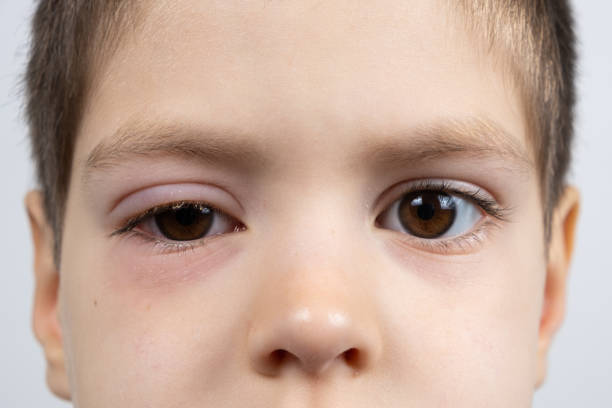 결막염이있는 어린이의 눈, 결막의 염증, 클로즈업. - conjunctivitis sore eyes child human eye 뉴스 사진 이미지