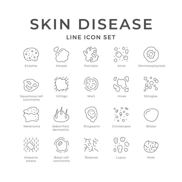 Set line icons of skin disease Set line icons of skin disease isolated on white. Eczema, shingles, acne, psoriasis, herpes, hives, melanoma, ringworm, dermatophytosis. Dermatology, skincare, health problem. Vector illustration shingles rash stock illustrations