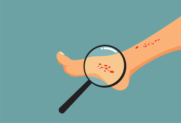 Person with Skin Eczema on the Foot Going Under Medical Examination Person undergoing a dermatological examination because of a skin rash tinea stock illustrations
