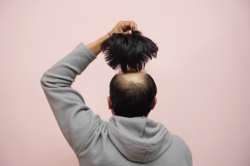 A closeup of a half-bald male removing his wig while wearing a hoodie with a pink background