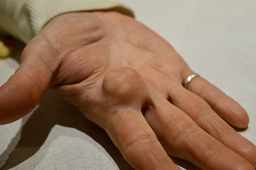 A closeup top view of a woman showing a round-shaped Lipoma fatty tumor on an open palm