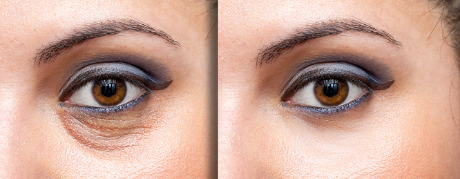A before and after makeup looks concealing the dark circles