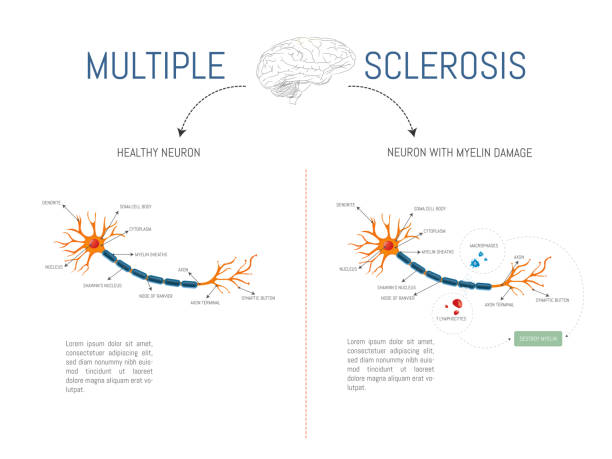 infografika egy egészséges neuronról, amely a mielinpusztító limfociták és makrofágok támadása által károsodott a sclerosis multiplex betegségben. - myelin sheath témájú stock illusztrációk
