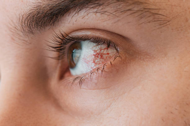 안과학. 인간의 눈은 빨간 혈관 메쉬와 안구에 염증이 있습니다. 결막염과 각막염의 개념 - sclera 뉴스 사진 이미지