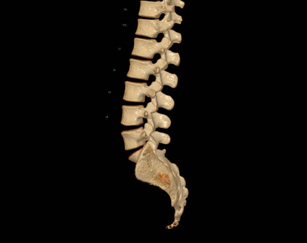 istock CT scan of Lumbar spine  3D rendering showing Profile Human Spine. 1442163910