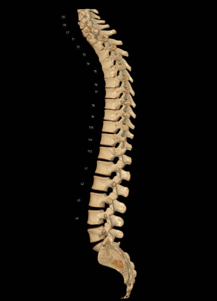 istock CT scan of Whole spine 3D rendering showing Profile Human Spine. 1442164327