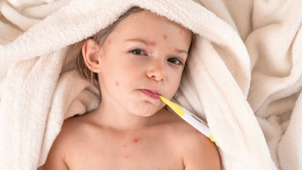istock Child with chicken pox lying in bed with Thermometer 1442322903