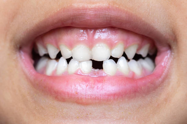 Macro of the mouth of a little girl who has lost a tooth Macro of the mouth of a little girl who has lost a baby tooth, infant teething concept baby teeth stock pictures, royalty-free photos & images