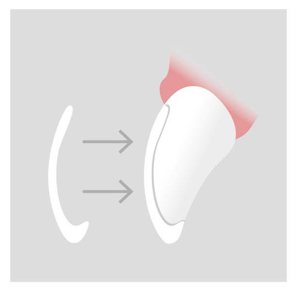 歯への歯科用セラミックベニヤの配置。歯科審美学。縦断ビュー、断面図。歯医者。ベクターイラスト。 - veneer点のイラスト素材／クリップアート素材／マンガ素材／アイコン素材