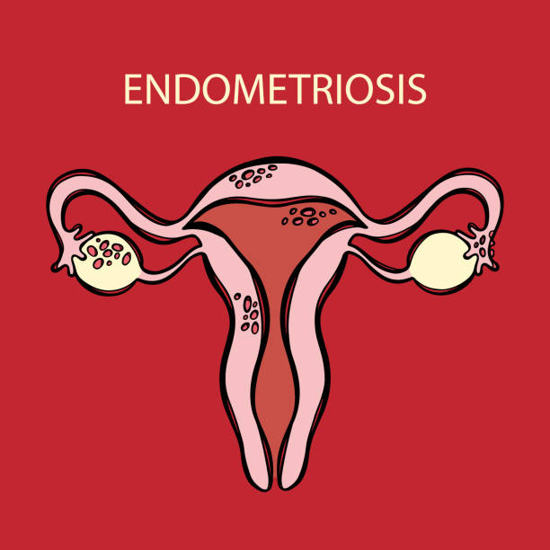 ENDOMETRIOSIS Female Reproductive System Medicine Education ENDOMETRIOSIS Female Reproductive System Cells Similar To Lining Of Uterus Grow Outside Hand Drawn For Medical Education Diagram Scheme Human Vector Sketch diagram of female reproductive system drawings stock illustrations