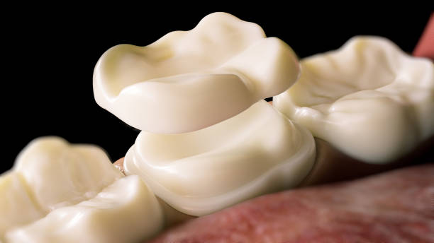 corona de superposición de cerámica sobre un diente: renderizado 3d - corona-dental fotografías e imágenes de stock