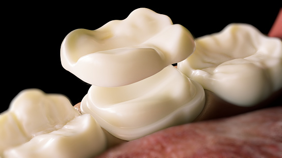 Ceramic Overlay crown over a tooth- 3D Rendering