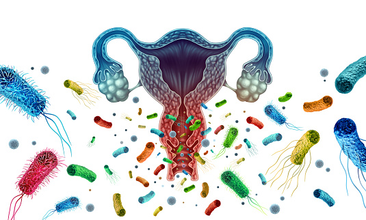Bacterial Vaginosis condition as a vaginal inflammation caused by bacteria infection in the vagina with 3D illustration elements.