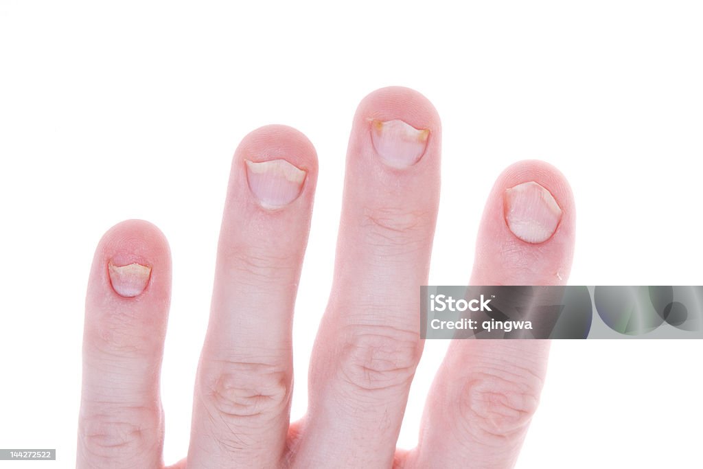 Psoriasis on Fingernails, Isolated White Background Shot of typical Psoriasis, a skin disease that has caused damage to these fingernails Fingernail Stock Photo