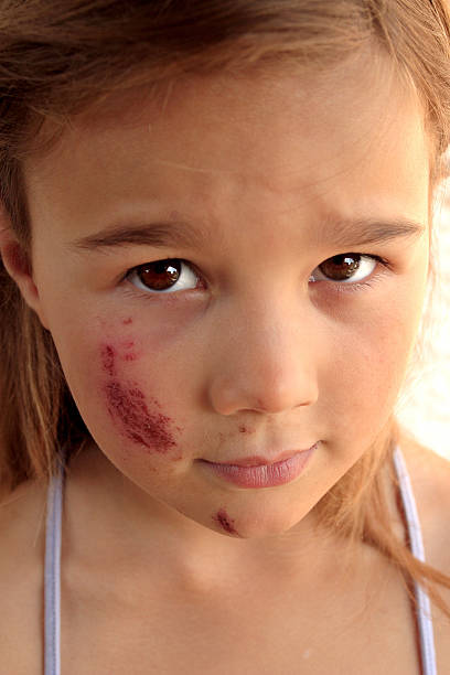 istock Pretty girl with grazed face 144272683