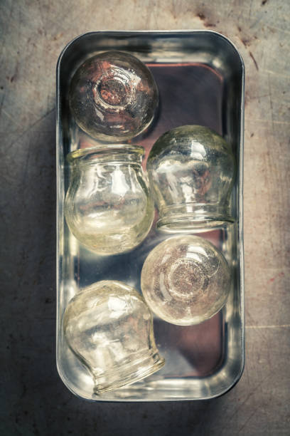 A hand arranges small glass cups on a person's back for cupping therapy. The warm, dimly lit setting suggests a spa or wellness environment, emphasizing relaxation and self-care. The scene conveys a sense of preparation for a soothing, therapeutic experience.
