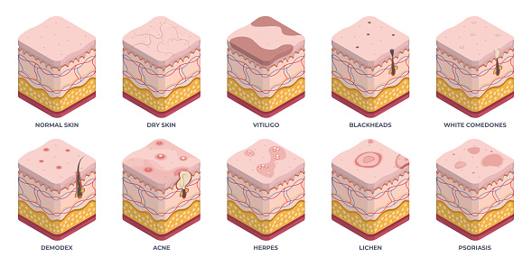 Isometric human skin types, 3d epidermis layers. Dermatology normal, oily and dry epidermis, skin structure problems, wrinkles, acne and rosacea flat vector illustration set. Epidermis layers