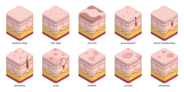 Isometric human skin types, 3d epidermis layers. Dermatology normal, oily and dry epidermis, skin structure problems, wrinkles, acne and rosacea flat vector illustration set. Epidermis layers Isometric human skin types, 3d epidermis layers. Dermatology normal, oily and dry epidermis, skin structure problems, wrinkles, acne and rosacea flat vector illustration set. Epidermis layers tissue anatomy stock illustrations