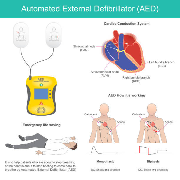 ilustraciones, imágenes clip art, dibujos animados e iconos de stock de desfibrilador externo automatizado. es un dispositivo electrónico para soporte vital que reconoce la fibrilación ventricular y otras arritmias y administra una descarga eléctrica en el momento adecuado. - fibrillation