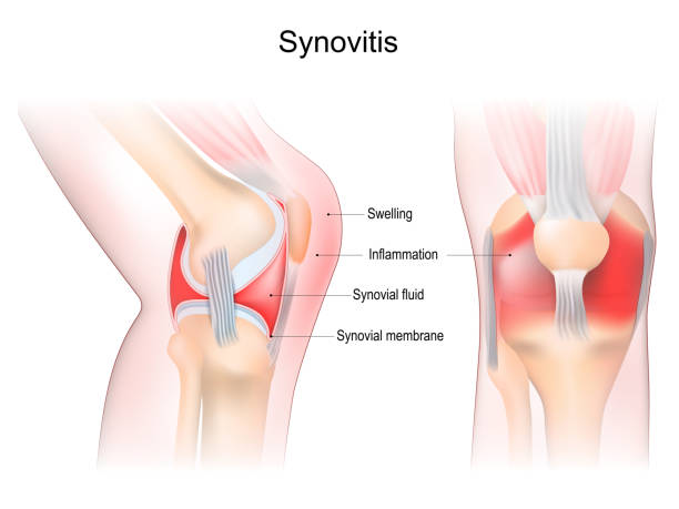 istock synovitis of a Knee. Frontal and side view of human knee joint 1442806071