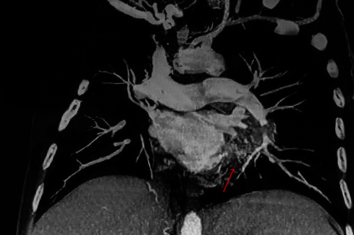 CAT Scan image pulmonary angiography showing lung adenocarcinoma with red arrow. Medical themes