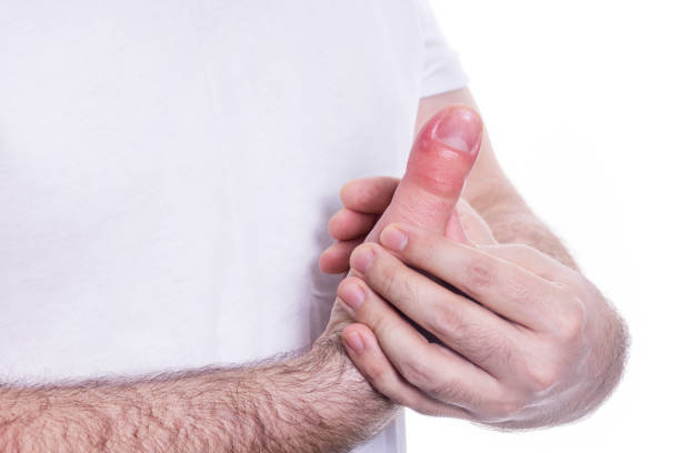 fragment of right hand with a swollen finger after a bee bite on white background, bigger due to allergy reaction after a wasp sting, red sensation on fingers and hands, finger wounded, skin irritation