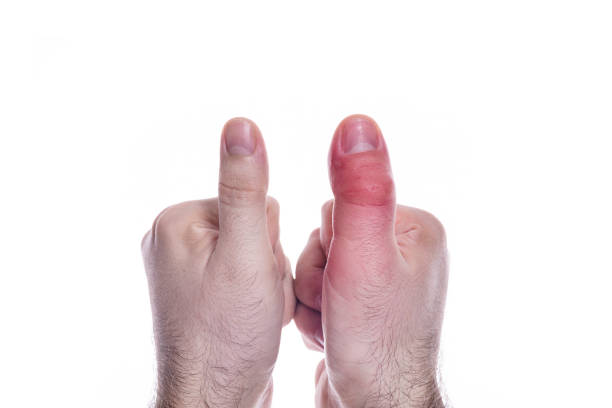 fragment of right hand with a swollen finger after a bee bite on white background, bigger due to allergy reaction after a wasp sting, red sensation on fingers and hands, finger wounded, skin irritation