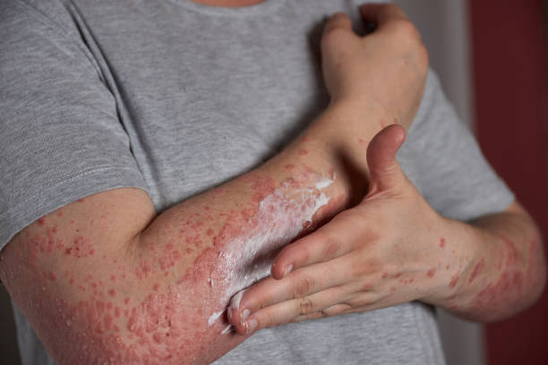 istock Applying moisturizer to skin with psoriasis 1442908636
