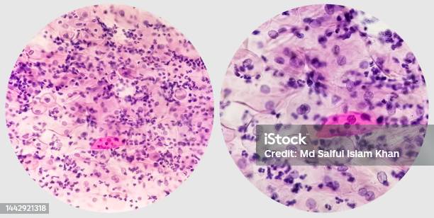 Paps Smear Photo Collage Of Two Microscopic Image Of Pap Smear Showing Paps Smear Photo Collage Of Two Microscopic Image Of Pap Smear Showing