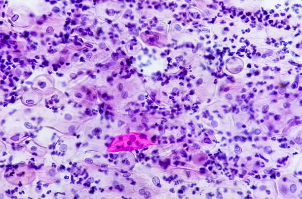 rozmaz papki. badanie mikroskopowe rozmazu papki wykazujące rozmaz zapalny z wczesnymi zmianami zanikowymi. nilm. rozpoznanie raka szyjki macicy. - cytologia zdjęcia i obrazy z banku zdjęć