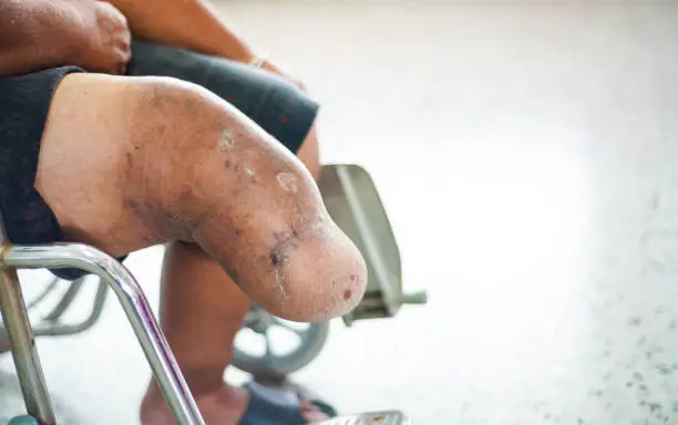 below knee amputation patient sitting on wheelchair