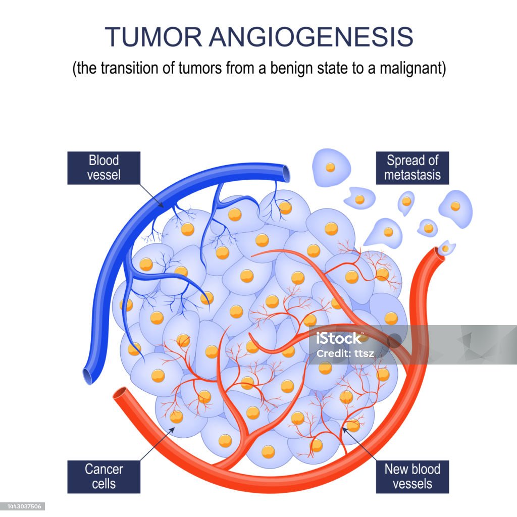 Angiogenesis Simple Vegfa And Tumour Angiogenesis – Angiogenesis In Tumors – ESYRXH