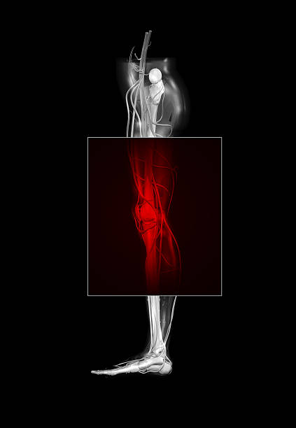 신체부위 통증 측면 뷰 (xxl - x ray human knee orthopedic equipment human bone 뉴스 사진 이미지