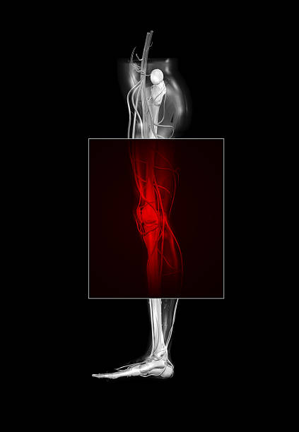 bóle nóg widok z boku (xxl - x ray human knee orthopedic equipment human bone zdjęcia i obrazy z banku zdjęć