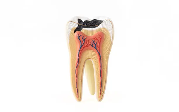 Isolated photo of internal tooth structure model with caries destruction on white background.