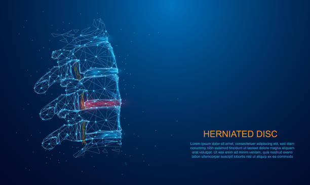 illustrazioni stock, clip art, cartoni animati e icone di tendenza di concetto di ernia del disco e diagnostica del dolore della colonna vertebrale in un design a basso poligono, particella e triangolo. struttura di connessione della luce wireframe. - human vertebra