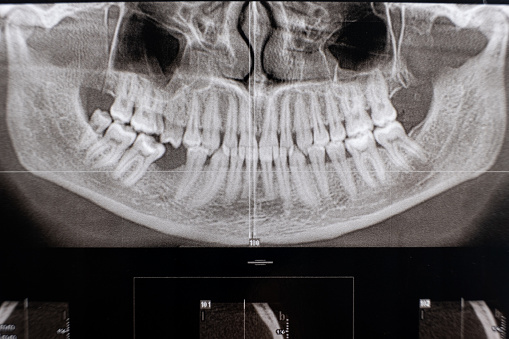 CT scan of a patient with missing chewing tooth and malocclusion.