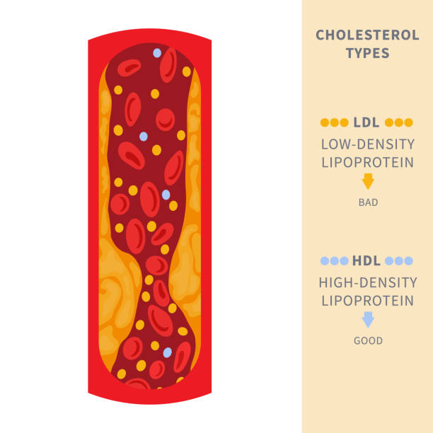 Cholesterol plaque buildup in blocked artery diagram Narrowed blood vessel with cholesterol plaque buildup. Artery blocked with a fat cells clot. ldl and hdl lipoprotein comparison. Cross section medical diagram. Vector illustration. excess fat stock illustrations