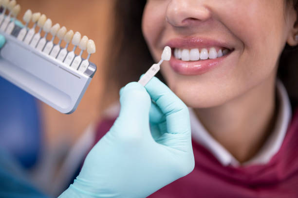 dentista usando una muestra de color de diente de paleta. - blanqueamiento dental fotografías e imágenes de stock