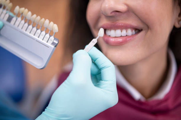 dentista che utilizza un campione di colore dei denti della tavolozza. - human teeth whitening dentist smiling foto e immagini stock