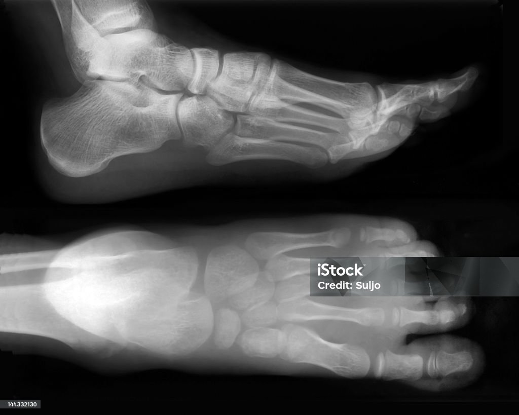 Foot-X-Ray Foot fingers exposed on x-ray black and white film X-ray Image Stock Photo