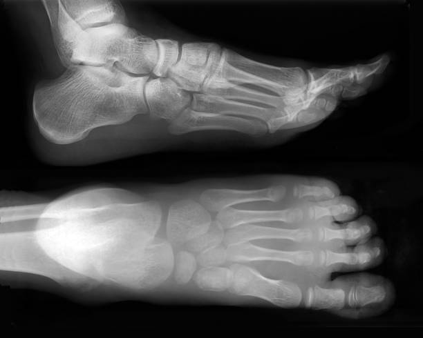 Broken Leg Xray Stock Photos, Pictures & Royalty-Free Images - iStock Broken Leg Xray Stock Photos, Pictures & Royalty-Free Images - iStock