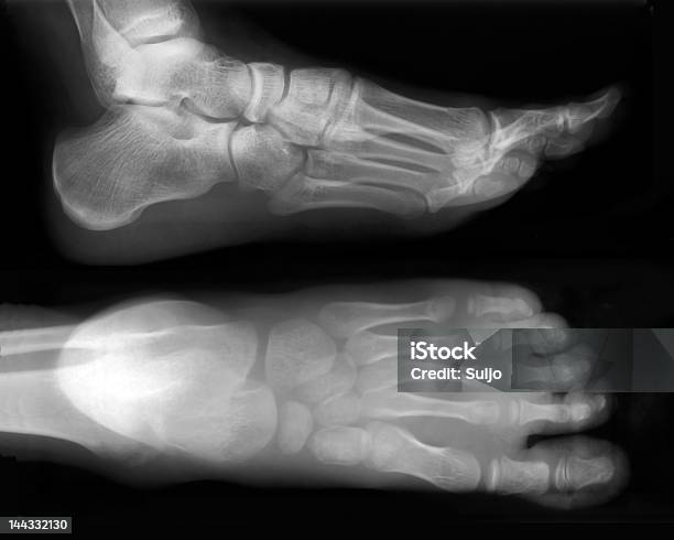 Footxray Stock Photo - Download Image Now - X-ray Image, Bone Fracture, Broken Leg