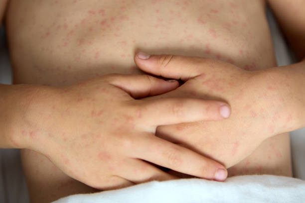 istock hands of a child with rubella, folded on the stomach 1443514219