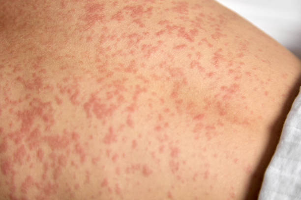 istock Human skin is covered with painful red spots 1443514443