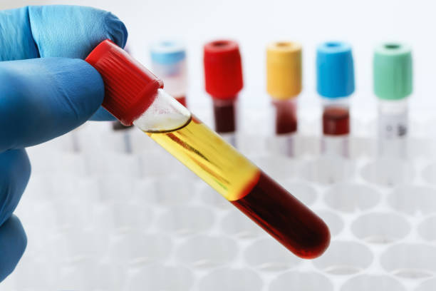 Lab technician holding a test tube of blood sample after being centrifuged Blood drawn from a patient with Serum separate in the chemistry laboratory. Lab technician holding a test tube of blood sample after being centrifuged serum sample stock pictures, royalty-free photos & images